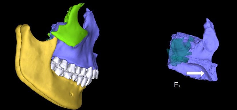 adult maxilla protraction 4