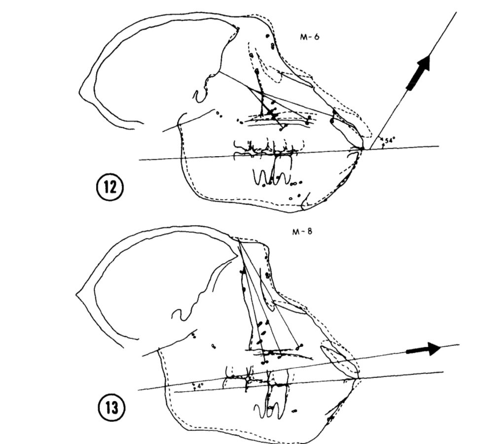 Proof: Moving the Maxilla is Possible in Adults