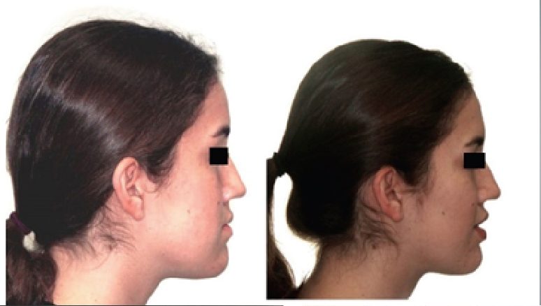 Mewing Appliance - A Device to Improve Your Facial Appearance