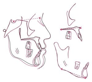 recessed maxilla before after