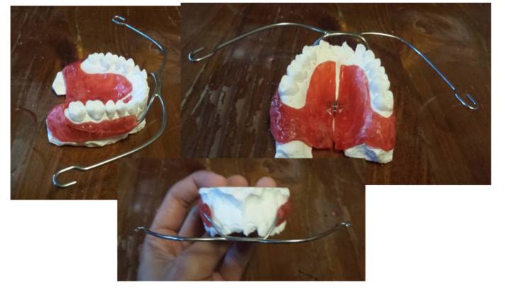 Intraoral Appliance