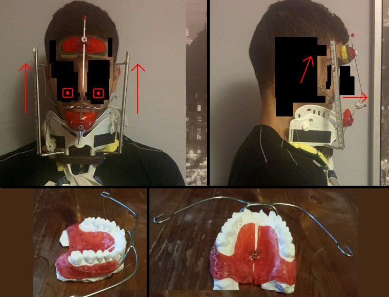 facepulling headgear with intraoral appliance