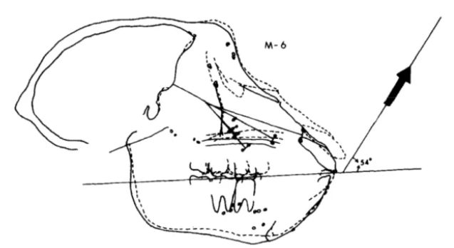 recessed maxilla before after 2