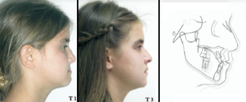 recessed maxilla before after 3