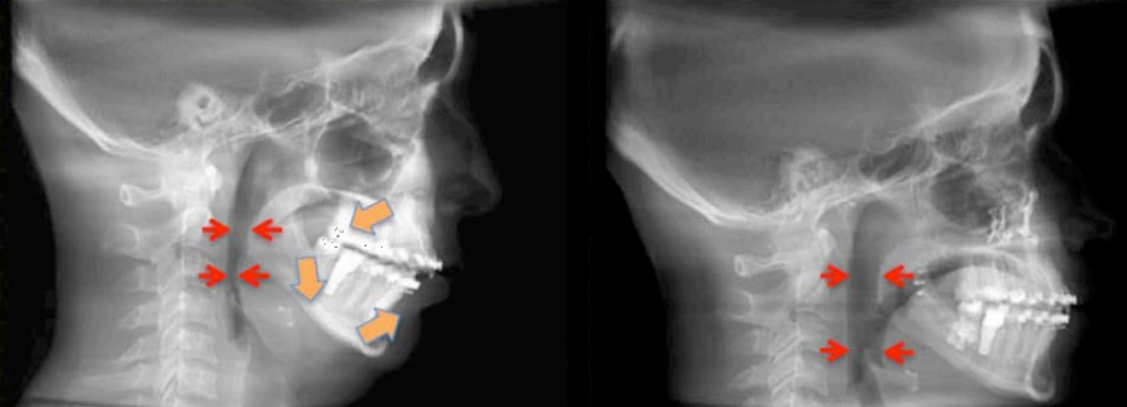 recessed maxilla causing a restricted airway