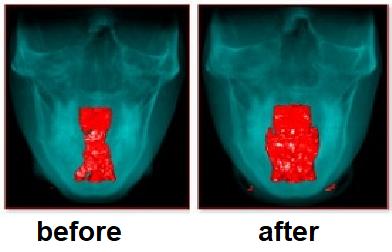 adult palate expansion airway