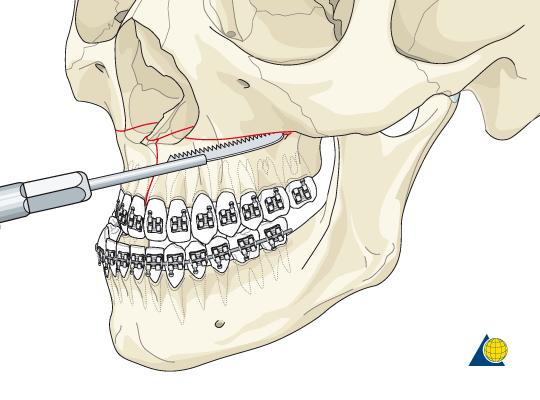 lefort 1 surgery