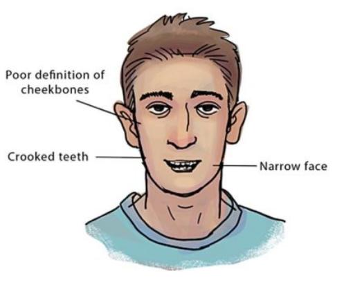 recessed maxilla